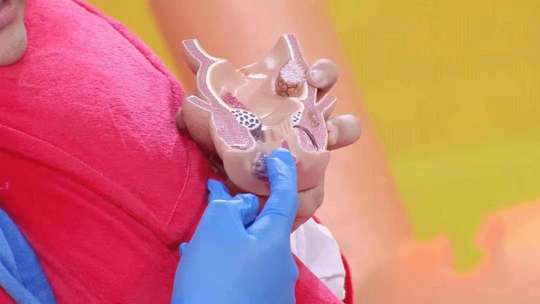 排便用力导致脑出血案例,排便太用力会有多危险需引起警惕