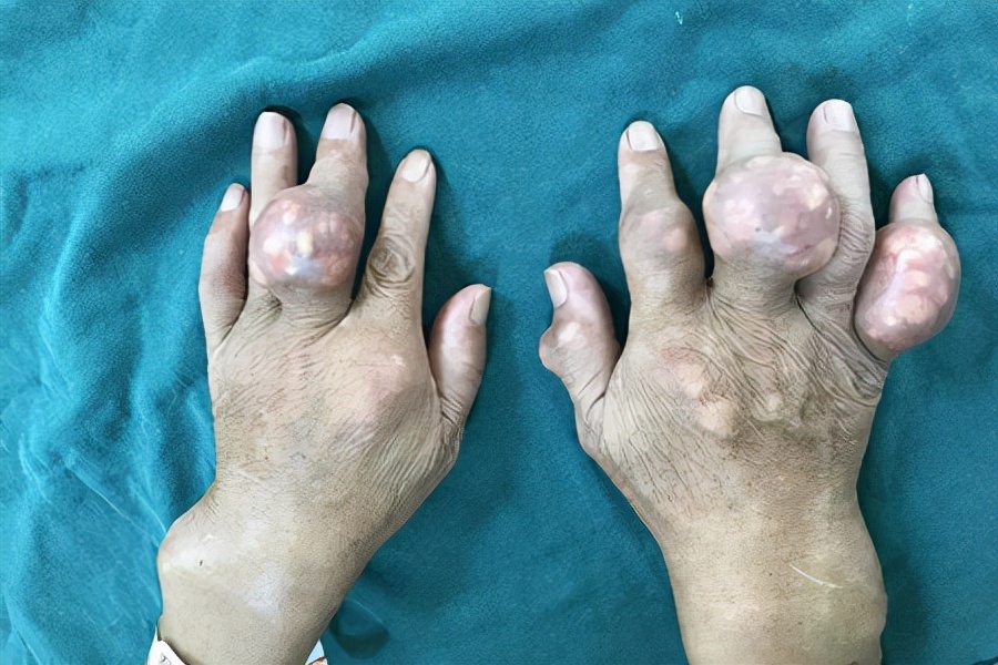 关节痛不要盲目判断滑膜炎,关节疼怎么判定是不是痛风