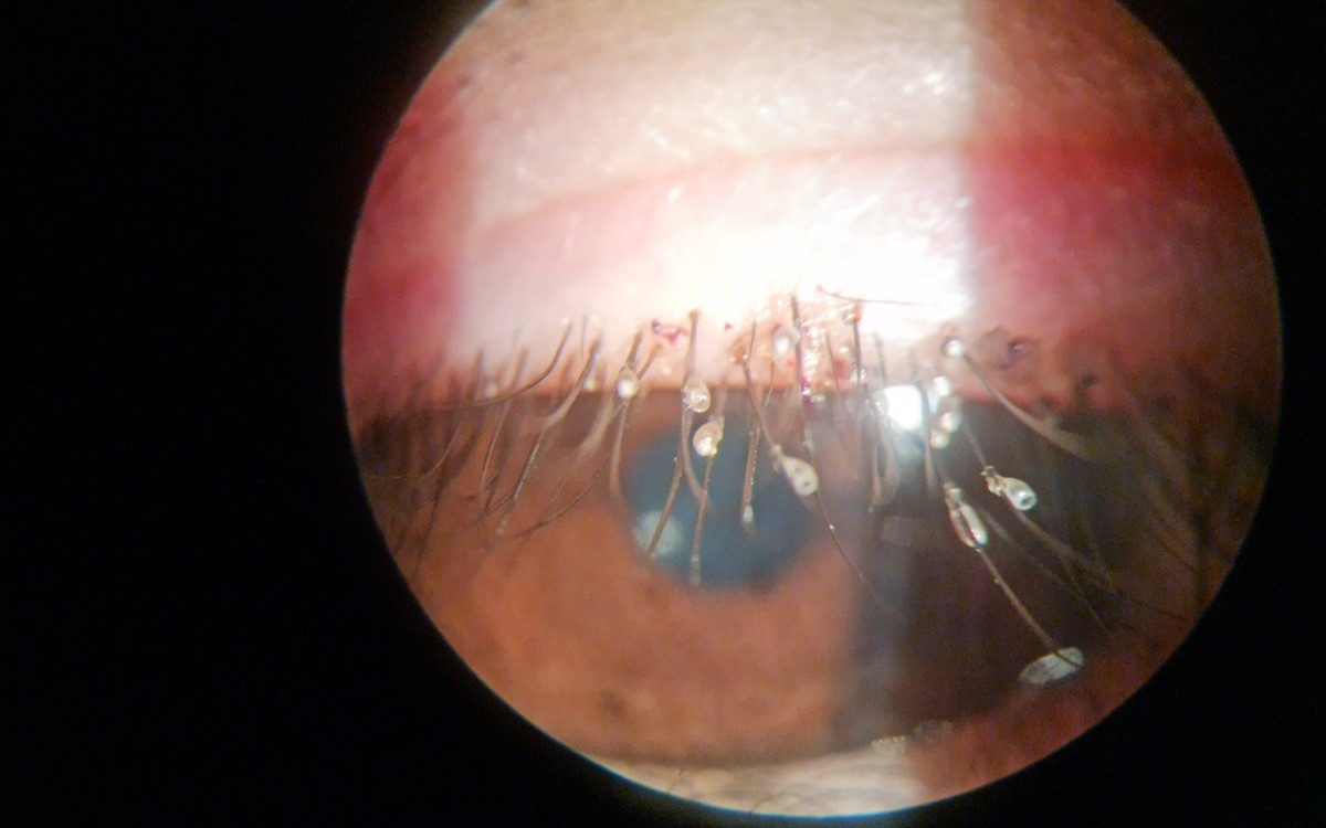 阴虱会传播性疾病吗,阴虱传播哪些疾病