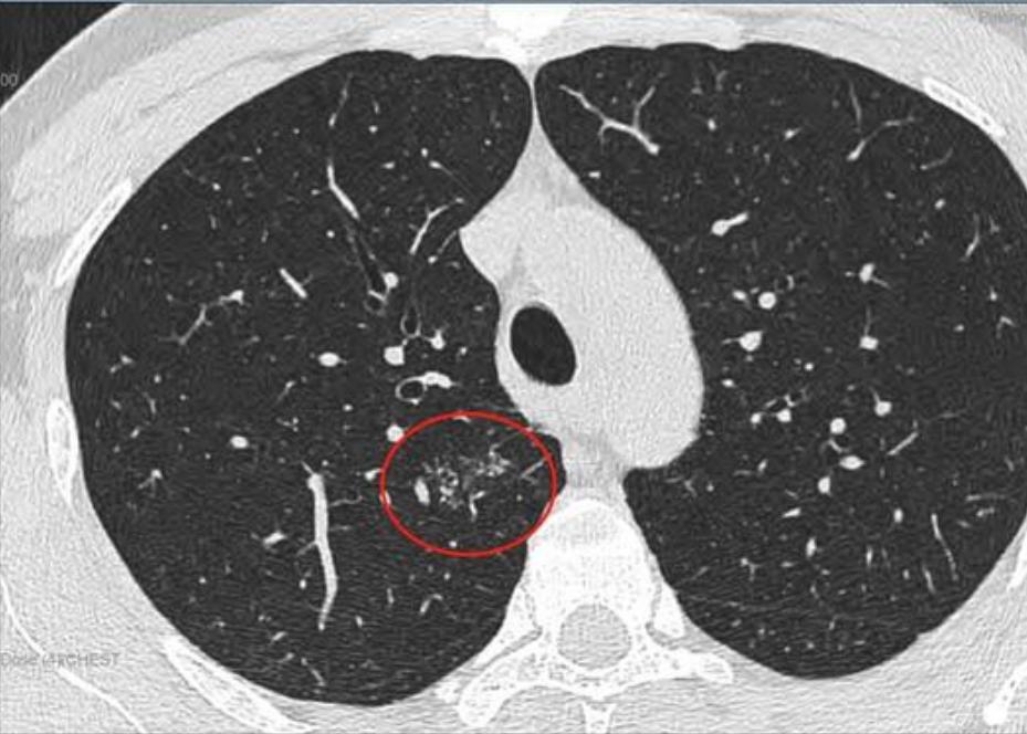 磨玻璃结节9*8mm建议随访,8mm磨玻璃结节一年没长