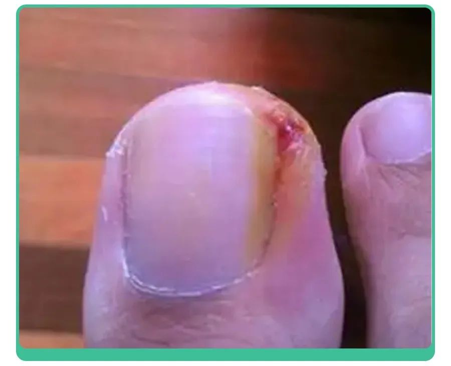 白斑、薄脆、凹陷，娃指甲有异常，不是缺营养，可能暗藏疾病