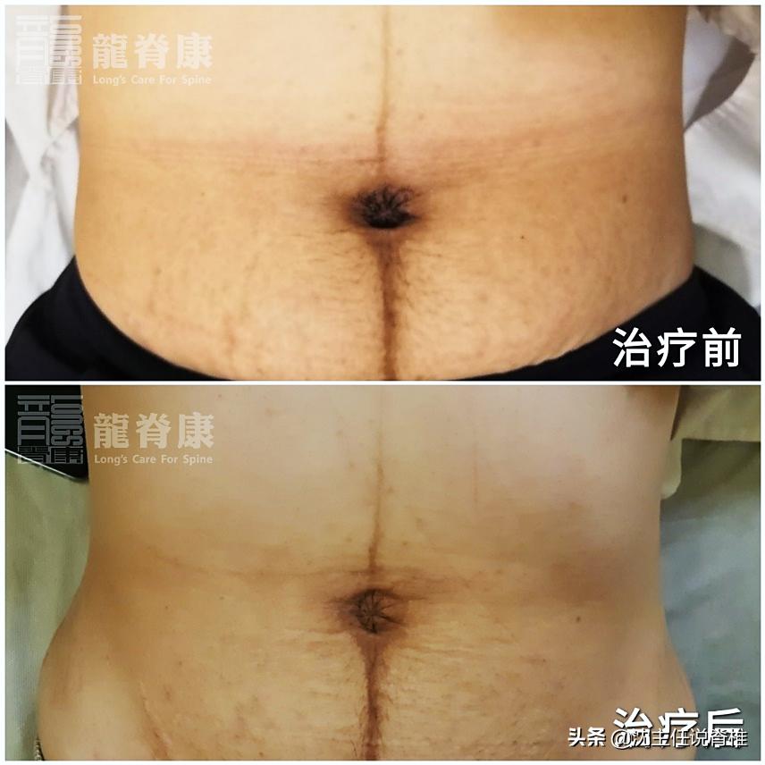 产后内脏下垂小腹突出,产后小腹突出怎么减