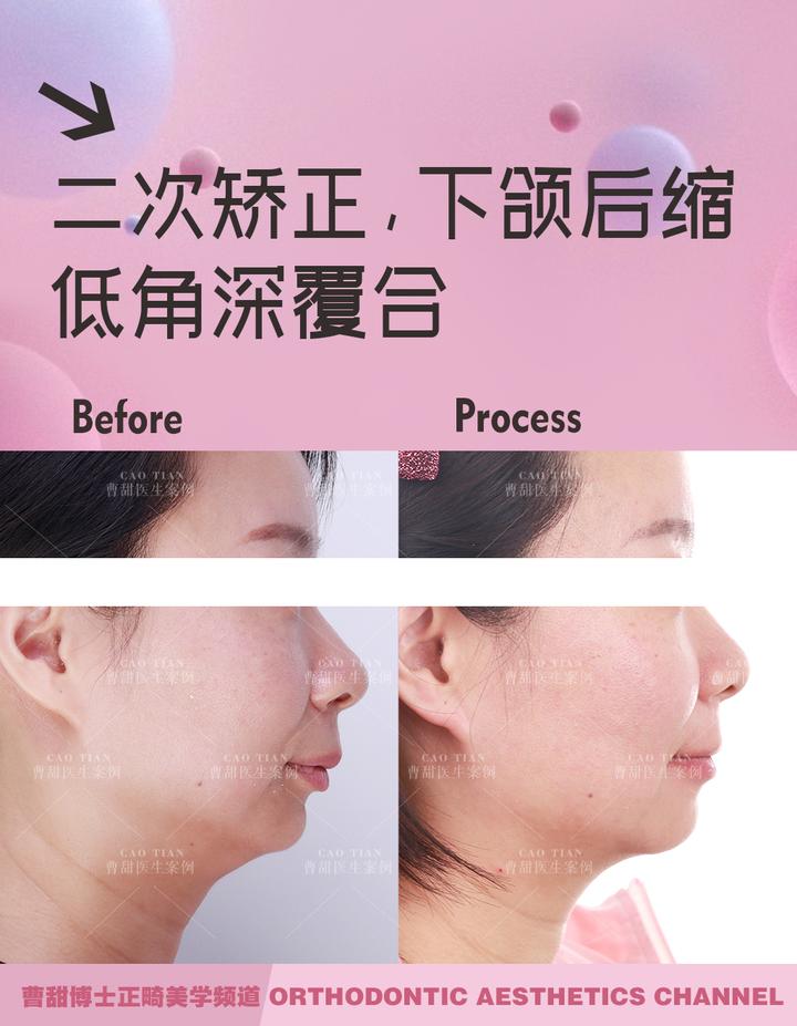 凸嘴下巴后缩拔牙改善有什么坏处,深覆合嘴凸下巴后缩矫正要拔牙吗