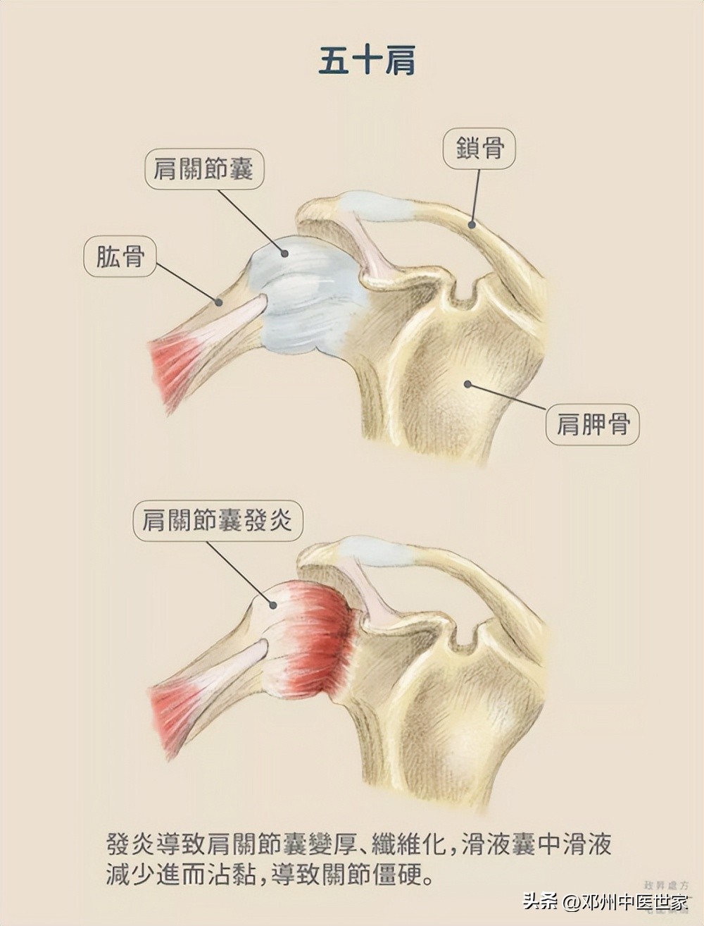 肩周炎治疗病历,肩周炎五十肩