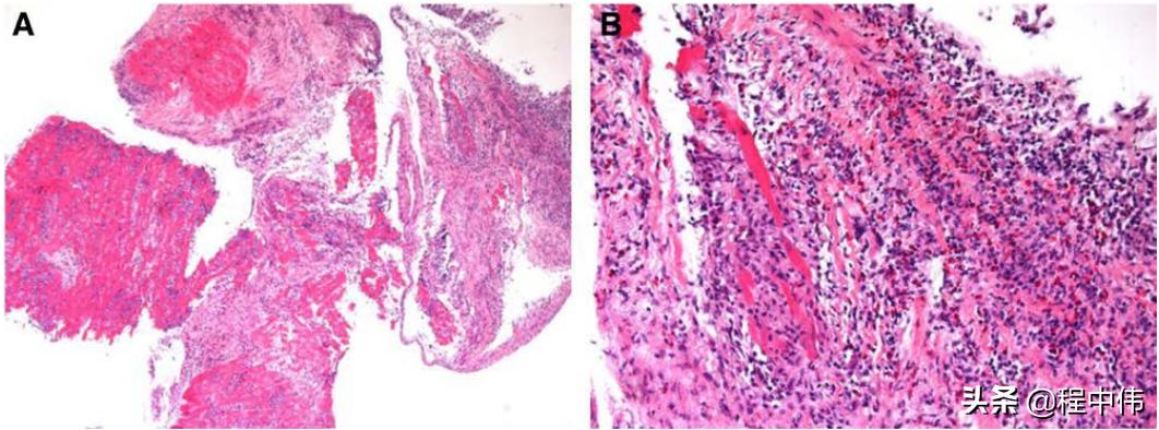 暴发性心肌炎及时发现治疗,最新病毒性心肌炎指南