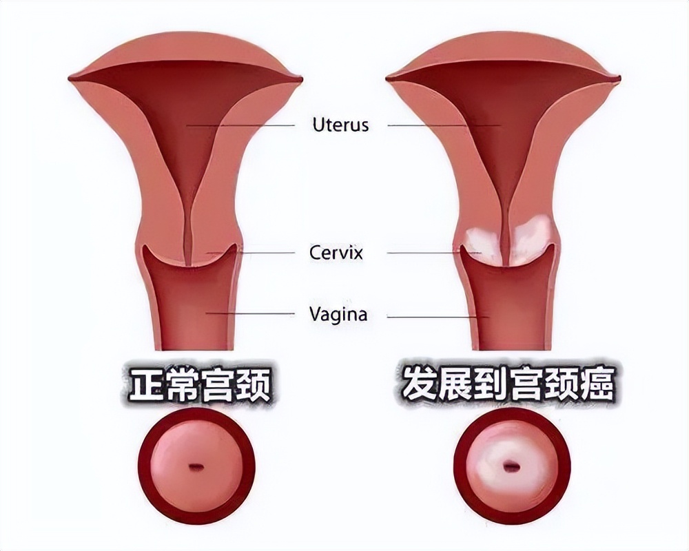 定期宫颈癌检查的目的是什么,宫颈癌定期复查的好处