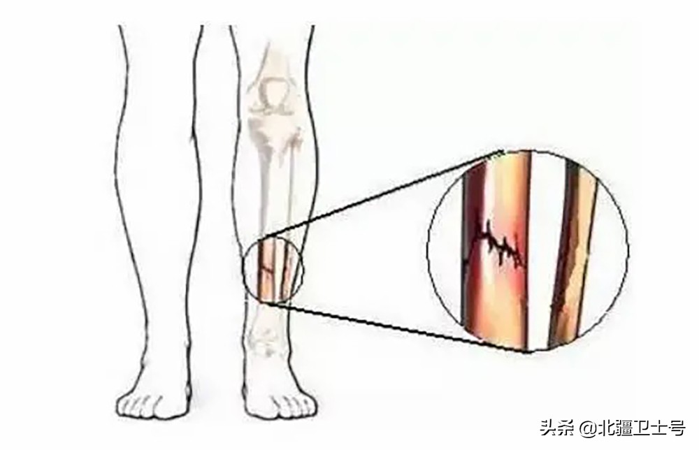 如何预防训练伤十条,如何正确预防训练伤