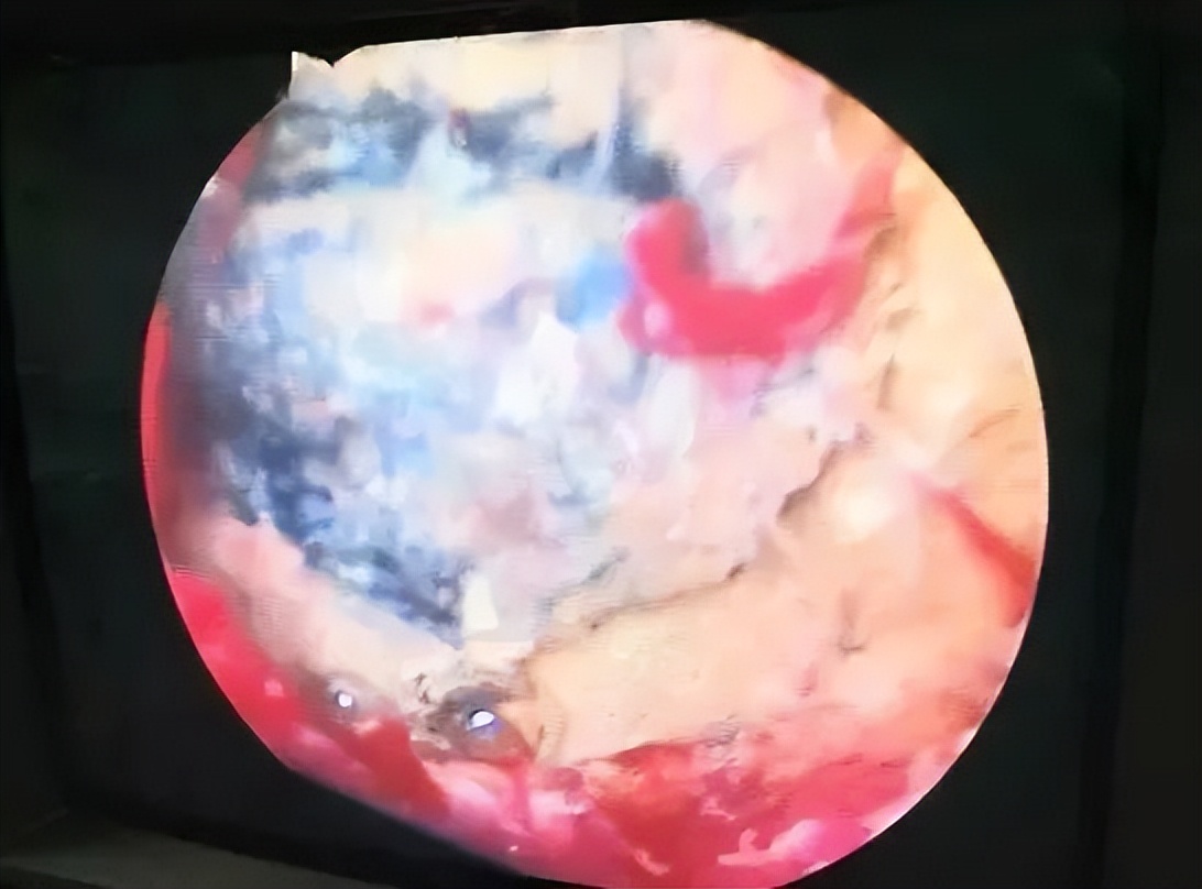 浙江6岁女童阴道内被这个小东西烧焦！祸因值得所有妈妈深思…