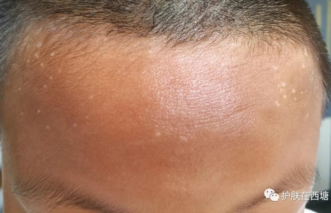 汗斑跟花斑癣,汗斑和花斑糠疹区别