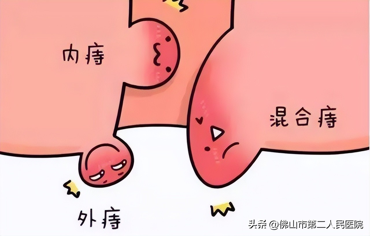 春节放肆嗨，节后便秘肛裂出血，难道是……