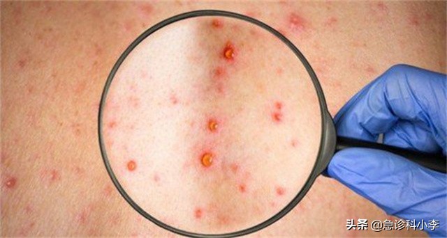 身上出现不痒的小红点是怎么回事,身上突然起了很多小红点不痛不痒