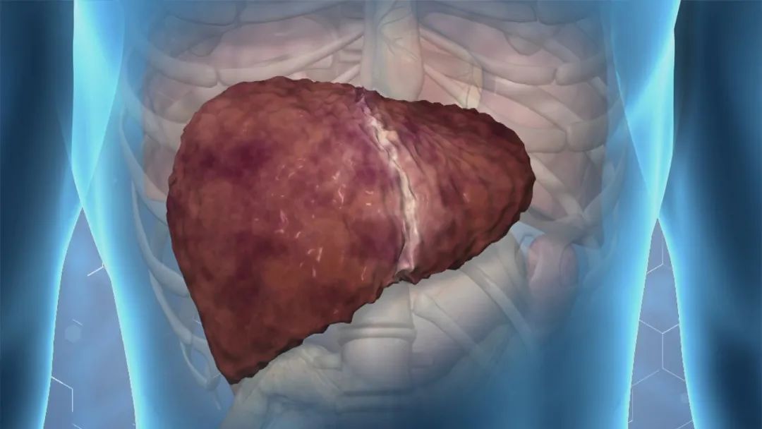 肝硬化为什么会出现腹水的现象,肝硬化腹水形成的因素不包括