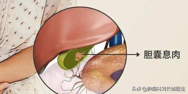 如何鉴别胆囊息肉与胆囊癌,胆囊息肉怎么区分良性恶性
