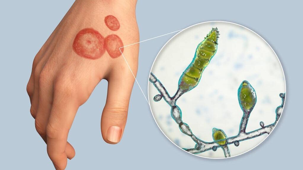 脚气怎么治才能除根没有瘙痒糜烂,3个实用方法根治脚气不复发