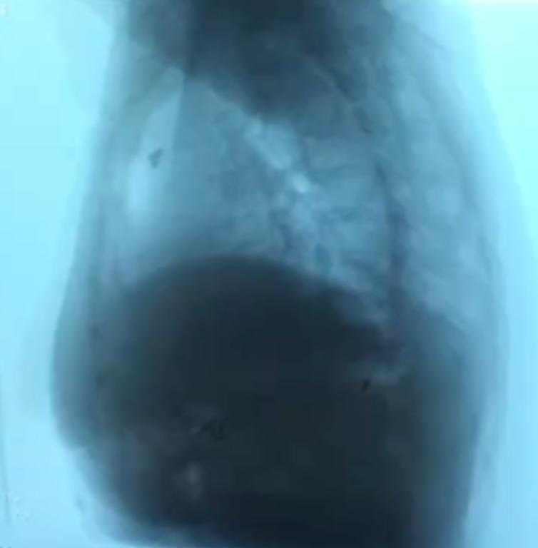 几十年间歇性胸闷气短去哪治疗,胸闷气短三年了怎么回事