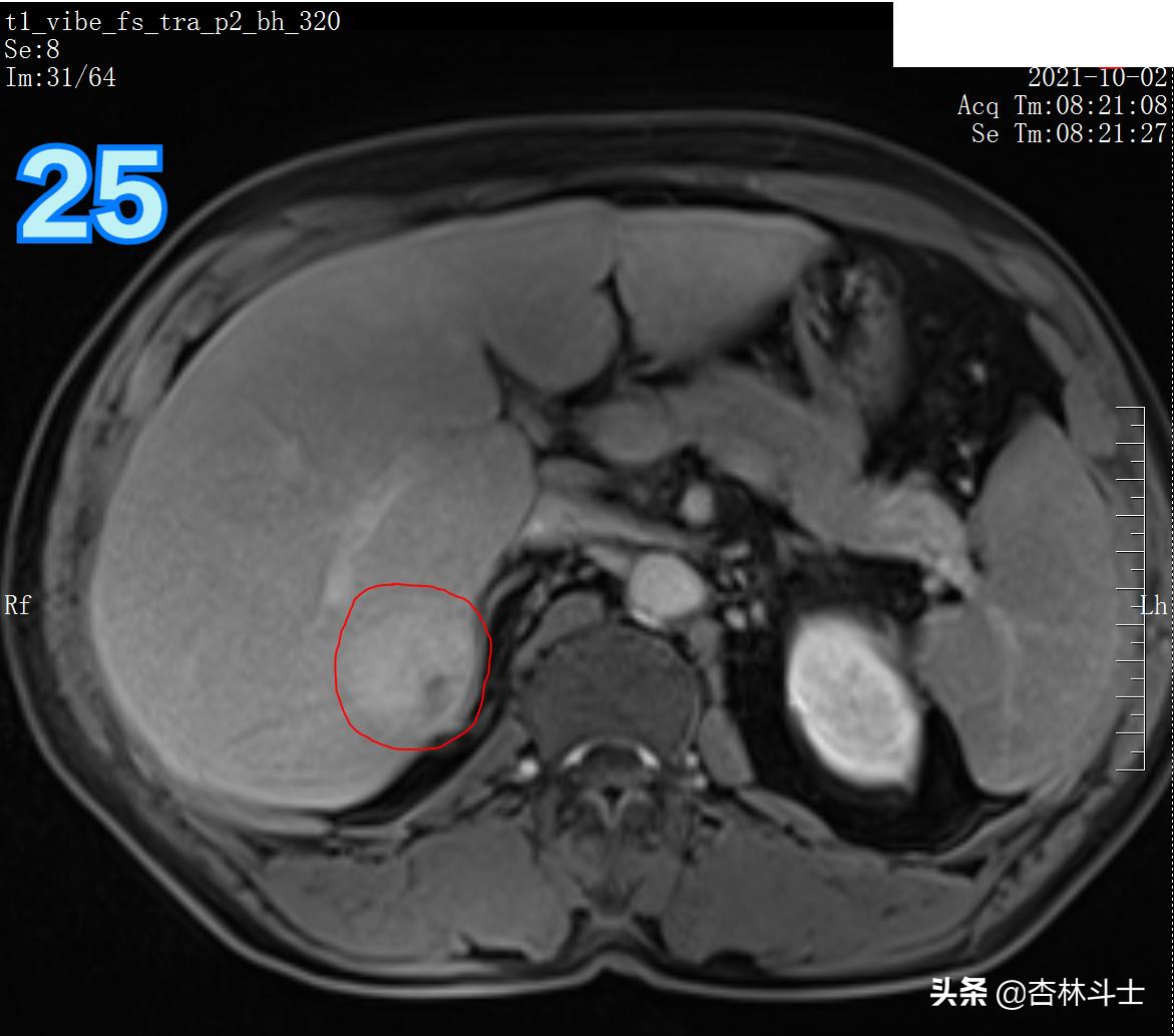 肝癌8公分肿瘤能活多久,肝癌细胞最大长多大