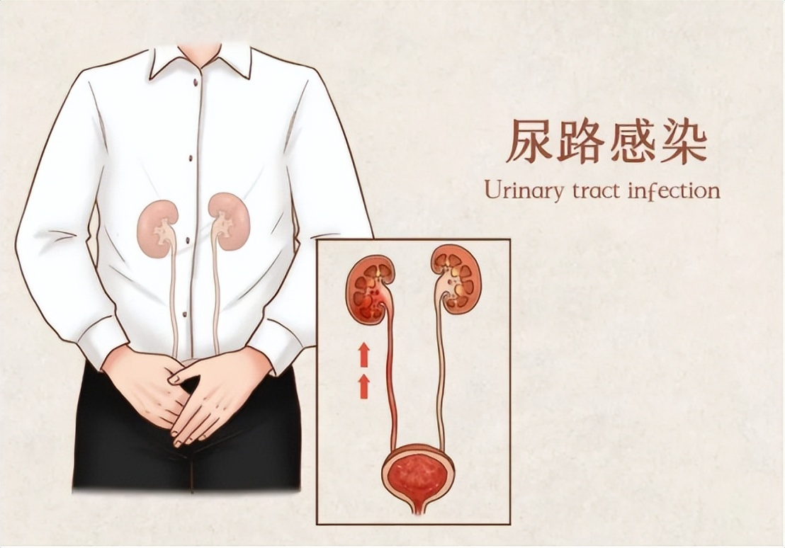 医院内尿路感染常见的诱因,尿路感染最严重的后果