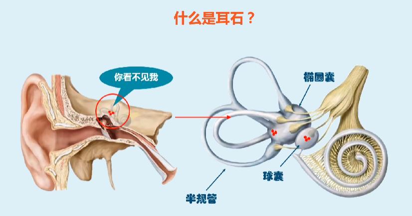 经常头晕目眩耳鸣怎么回事,耳朵里有石头头晕