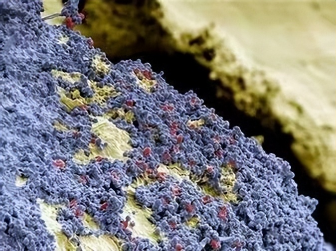 牙缝里的牙结石，如何清除干净？医生：2个办法是不少人的选择