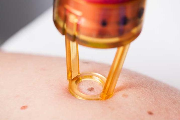 可以一个人取痣吗,点痣如何不翻车