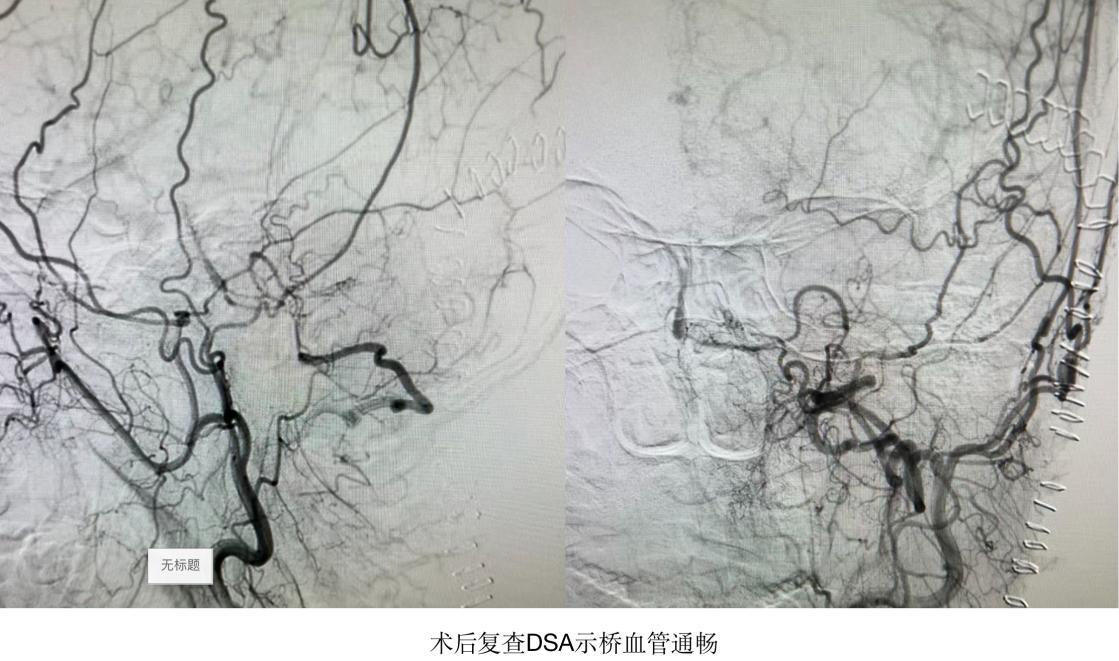 哈尔滨医大一医院脑动脉手术,哈医大一院脑神经外科