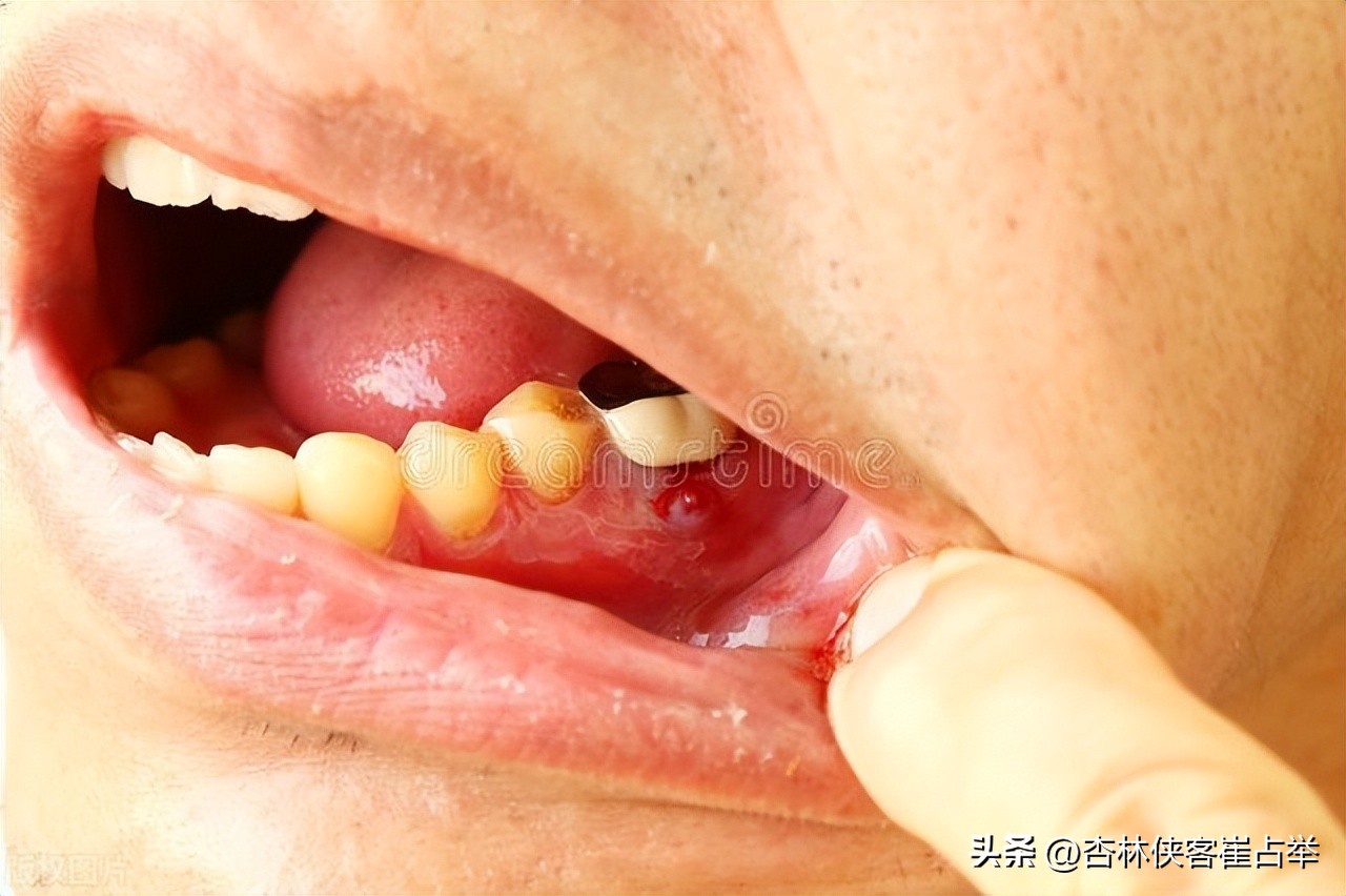 心火胃火肝火肺火吃什么中成药,治肝火胃火肺火心火肾火的中成药