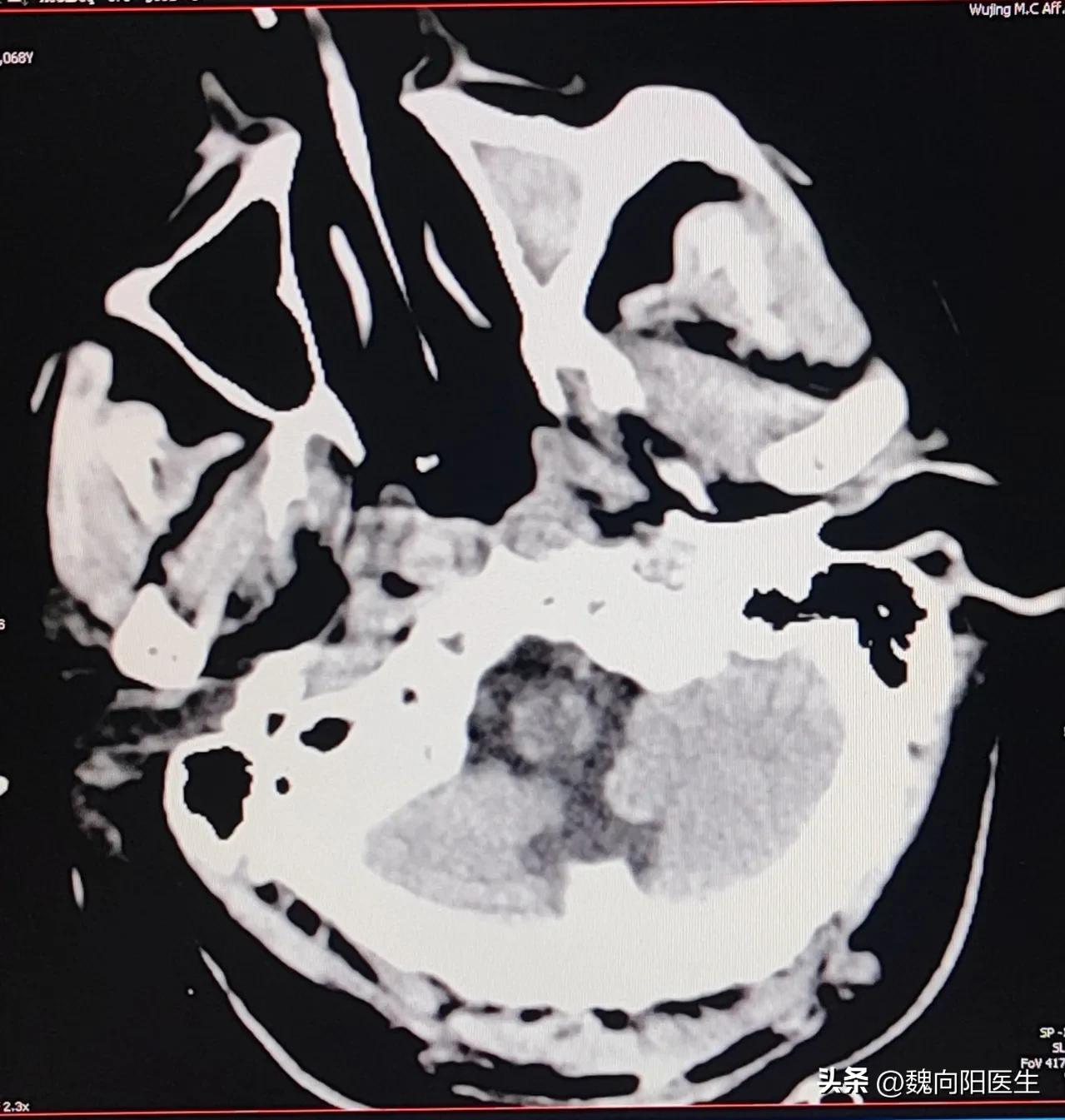 我的父亲大面积脑梗,我父亲脑梗3年后歪着坐在轮椅上