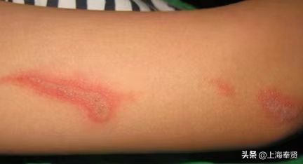 夏季被虫子咬了怎么办,夏季皮肤病攻略虫咬感染篇