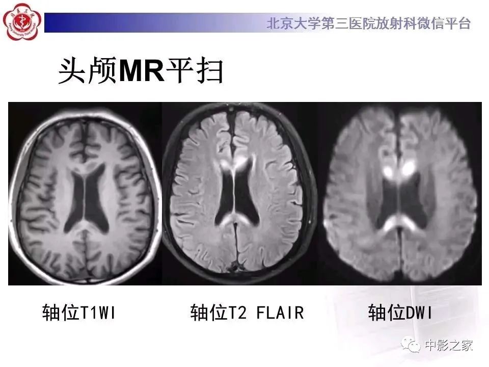 什么叫原发性胼胝体变性,原发性胼胝体变性治疗多少钱