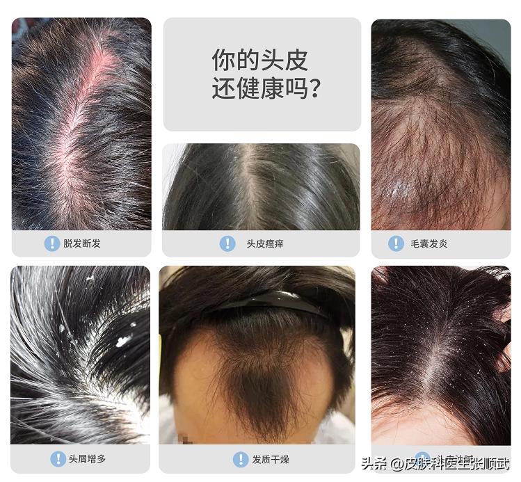 小孩多剃光头可使头发变多吗,大人剃光头能让头发变好吗