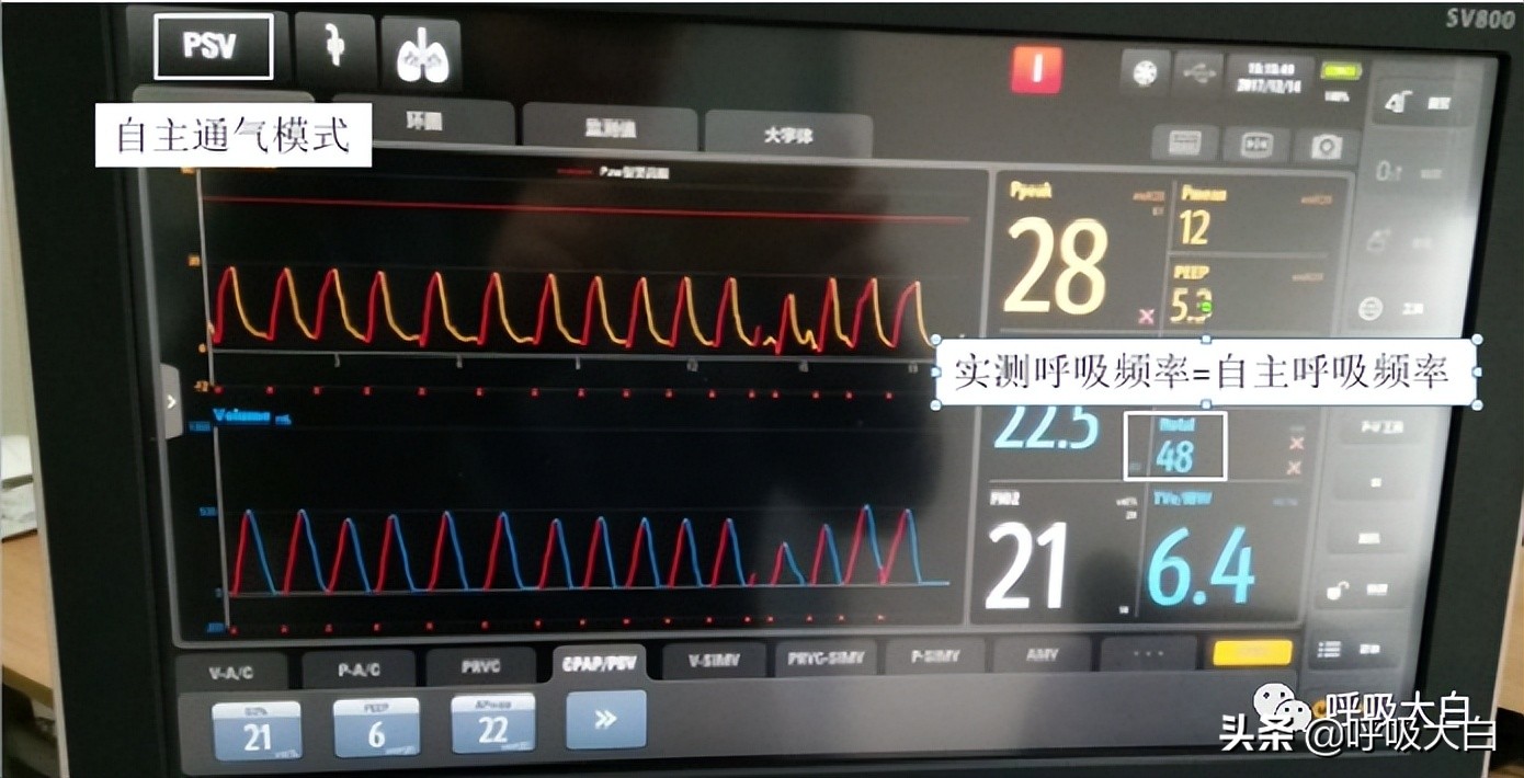 呼吸机设置：呼吸频率+吸呼比