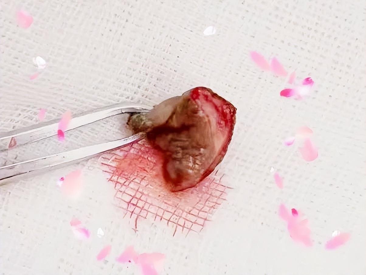 门医技术|外阴小肿物，病理大问题！