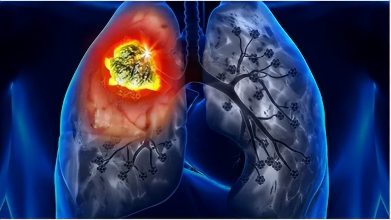 脂肪肉瘤和脂肪瘤摸着区别,脂肪瘤很常见吗