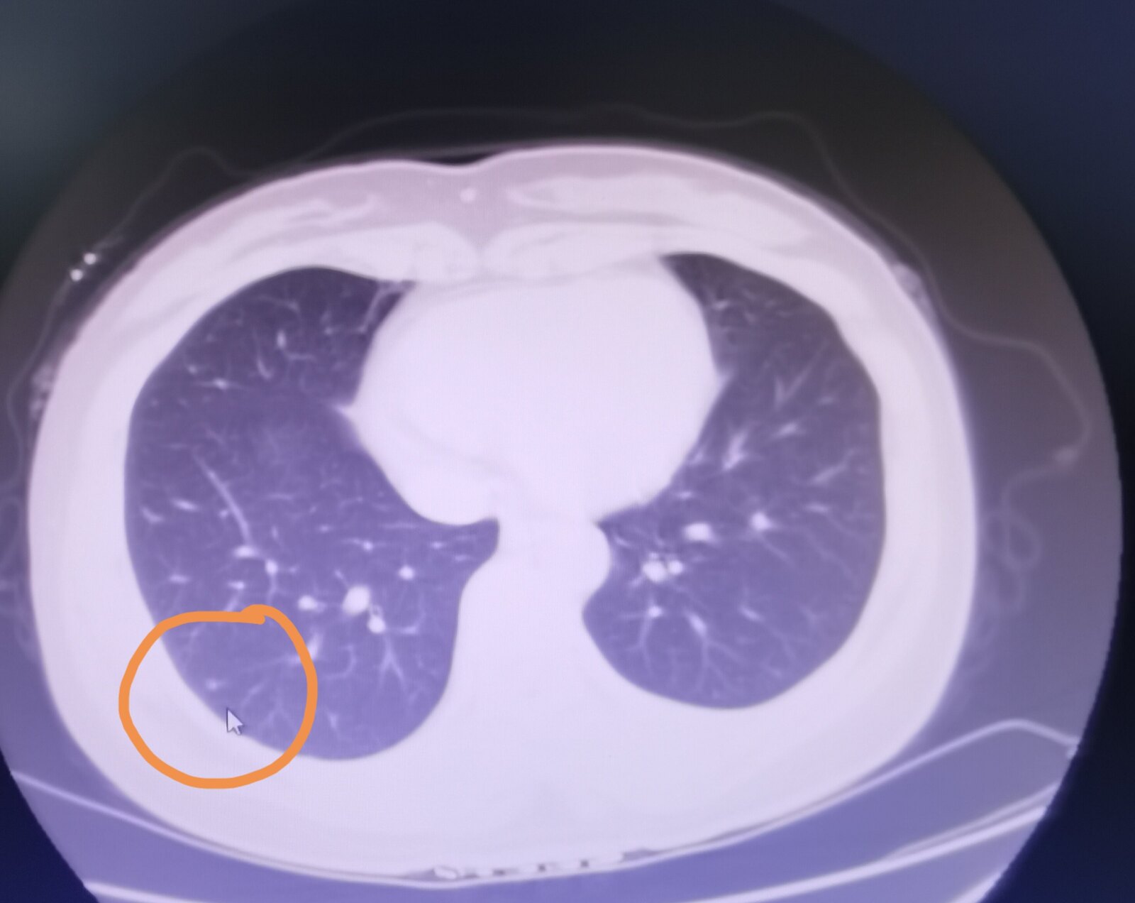 刘懿博士说肺原位癌,刘懿博士说肺癌脑转移