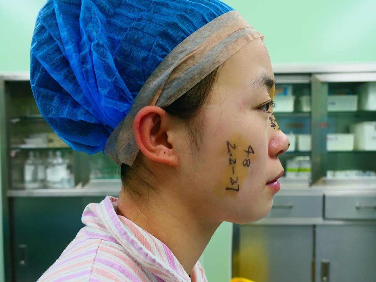 25岁天津女孩,19岁女子瞒着父母去整容