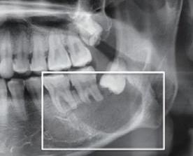牙根腐烂要怎么治疗才可以恢复,牙根腐烂怎么治疗最快