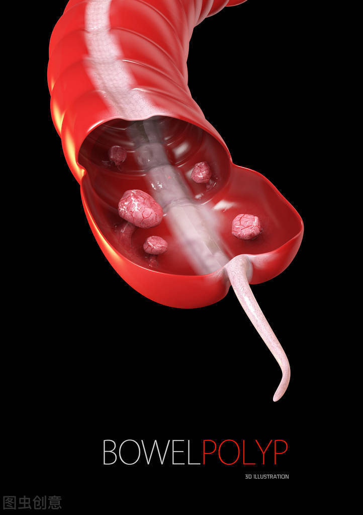 关于肠癌你不知道的那些事,胆囊息肉你不知道的知识点都在这