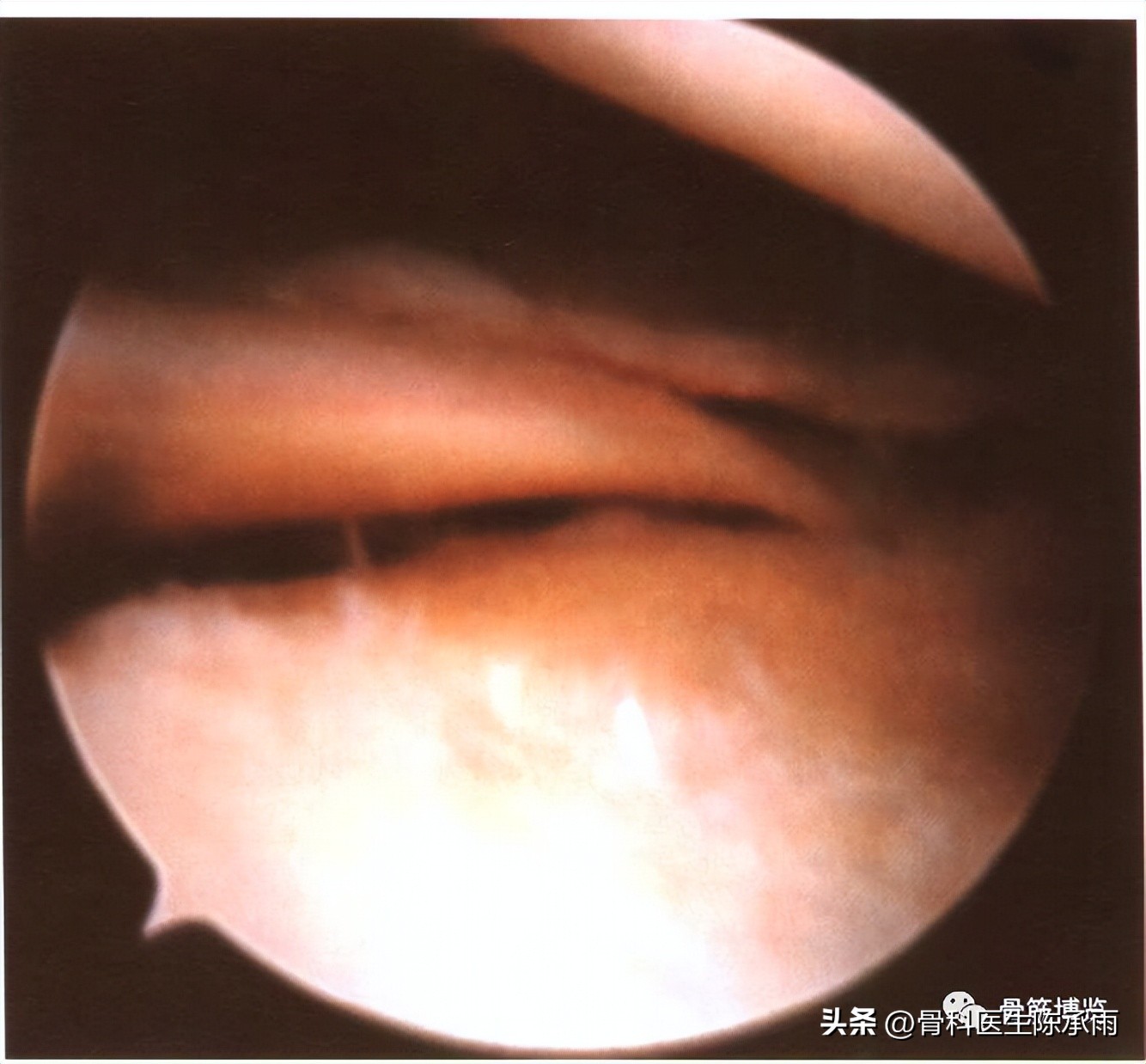 盘状半月板撕裂一级,半月板层裂愈合概率