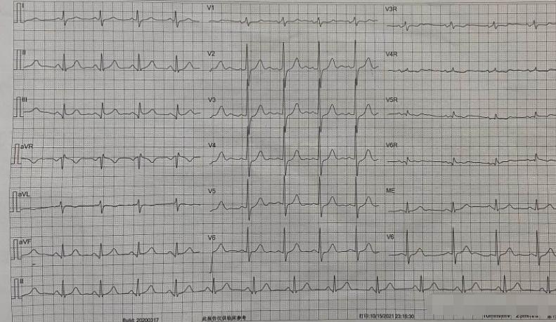 男子酒后说胳膊疼，医院检查心电图“无异常”，主任：赶紧抢救