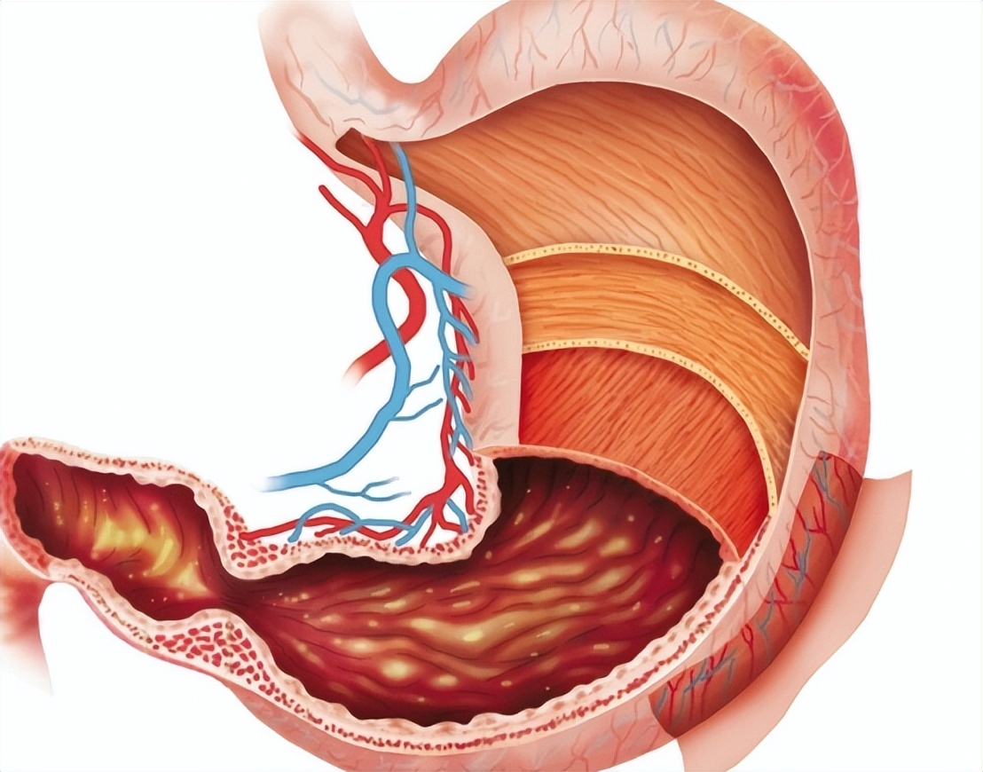 胃癌中晚期恶性肿瘤怎么治疗好,恶性程度低的胃癌