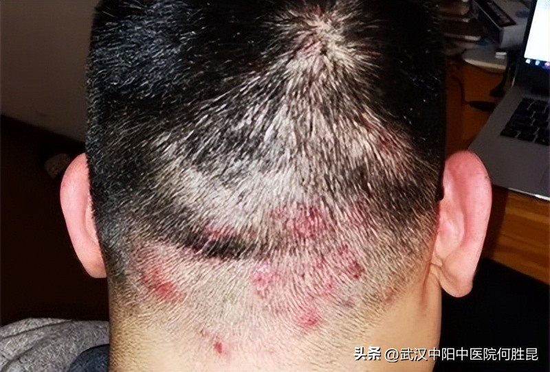 脖子后面长了黑痣老是长脓,脖子后面脓包没有脓了都是血