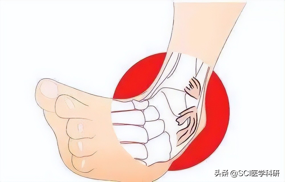 崴脚第一时间应该怎么处理,崴了脚第一时间怎么处理