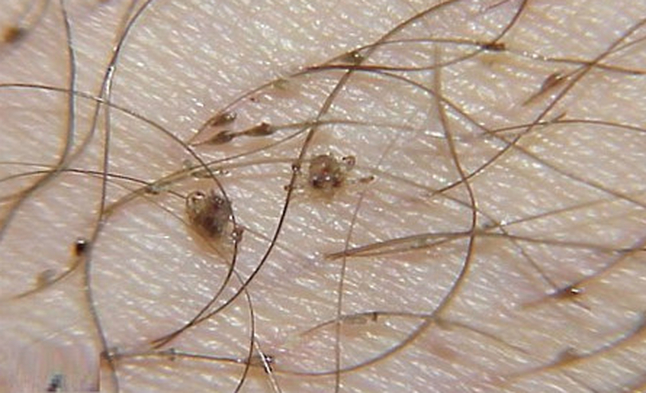 男子腹部痒,医生用镊子夹出16只阴虱!原来阴虱的传播途径有4个