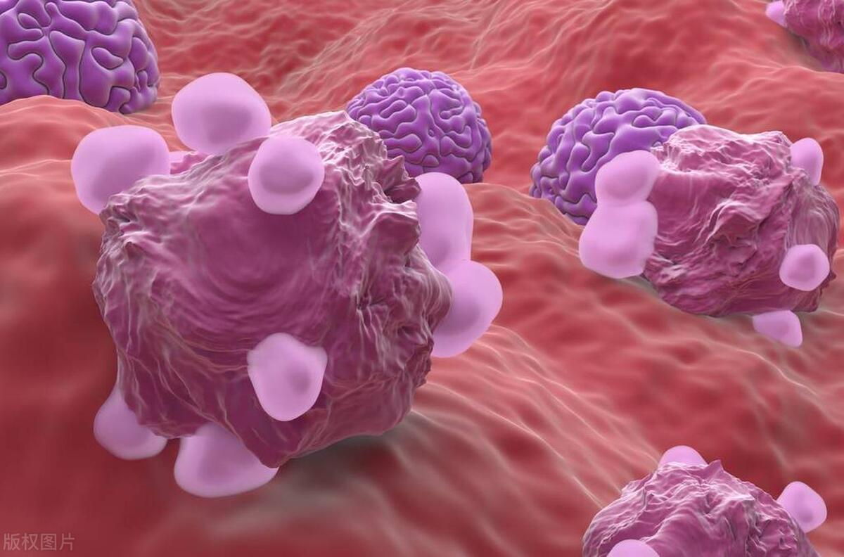 卵巢癌晚期有三个早期表现,卵巢癌一发现就是晚期