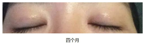 全切双眼皮术后下唇出现多层褶皱,为什么双眼皮术后反而遮瞳孔了