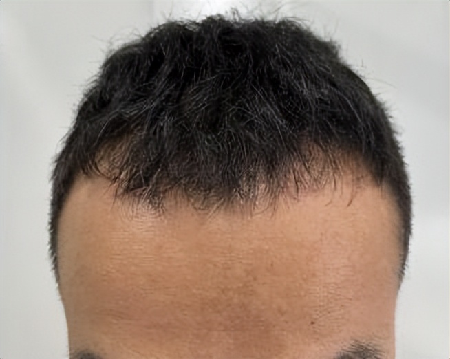 脱发后毛发还能移植吗,毛发移植会脱发吗