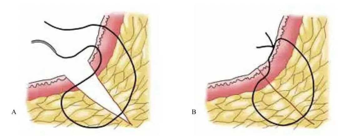 3分钟get:真正的外科缝合秘籍