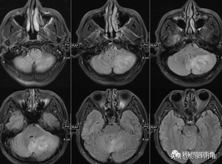 脑部局灶性强化是什么意思,脑部环形强化灶是什么意思