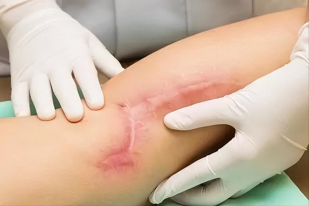 疤痕治疗在医药费赔偿范围内吗,疤痕治疗费用有纳入医保吗