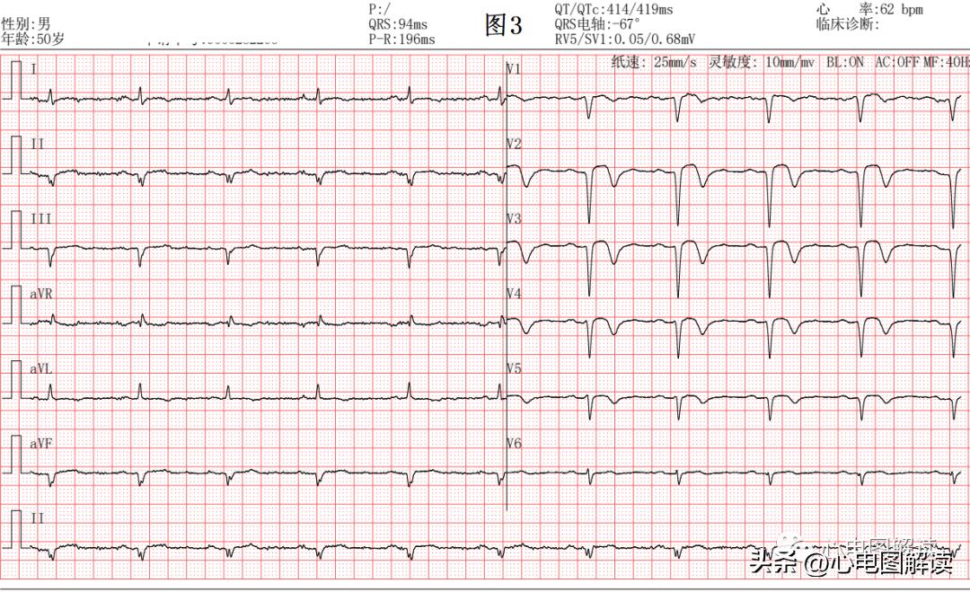 II、III、aVF导联的正常q波、异常Q波
